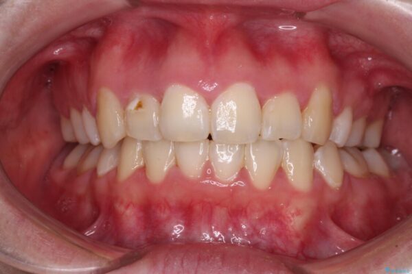 骨格的なズレをカムフラージュ　抜歯矯正で咬み合わせを改善 治療後画像
