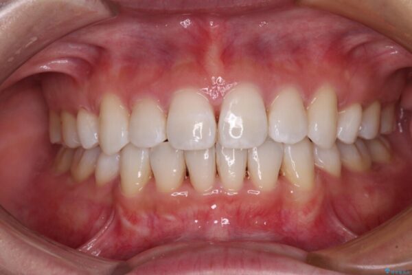 出っ歯を改善　目立たないワイヤー装置での抜歯矯正 治療後画像