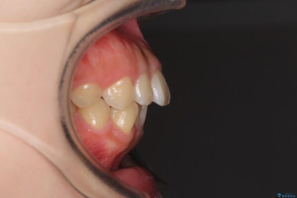 口元を引っ込めたい　目立たないワイヤー装置での抜歯矯正 治療前画像