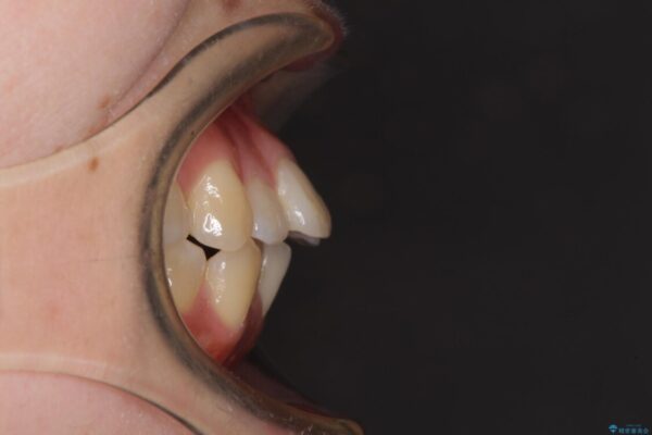 出っ歯を改善　目立たないワイヤー装置での抜歯矯正 治療前画像
