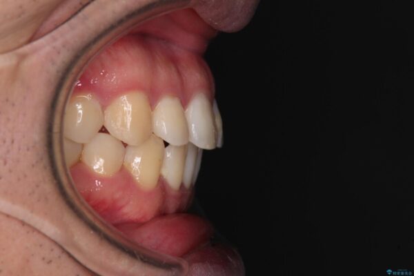 インビザラインで奥歯の咬み合わせと前歯のデコボコを改善 治療後画像