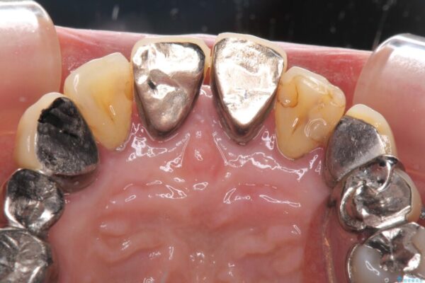 銀歯や入れ歯で汚い歯をきれいにしたい　総合歯科治療 治療前画像