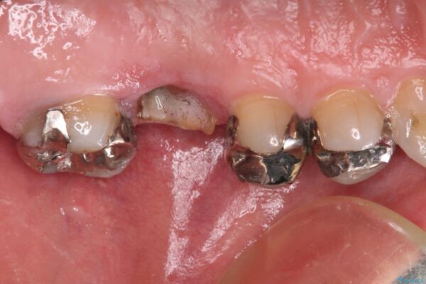 欠損と痛み　奥歯のむし歯治療 治療前画像