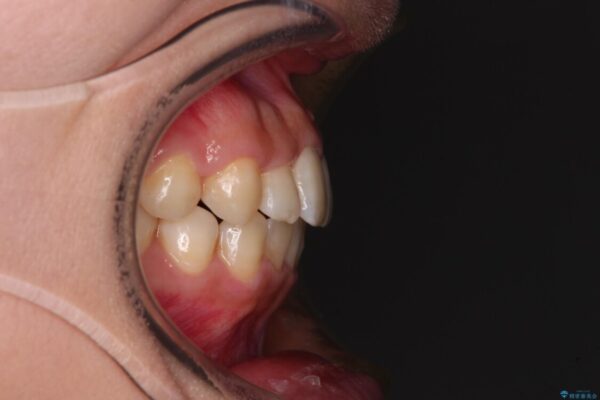 前歯のクロスバイト　目立たないワイヤー装置で速やかに矯正治療 治療後画像