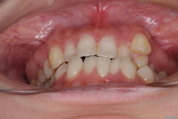 八重歯と前歯の欠損と骨格のズレ　目立たないワイヤー矯正 治療前画像