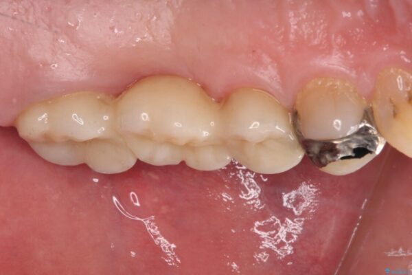 欠損と痛み　奥歯のむし歯治療 治療後画像