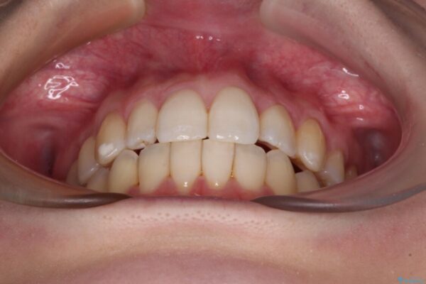 補助装置を併用したインビザラインでの八重歯の抜歯矯正 治療後画像