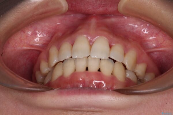Eラインを改善したい　ハーフリンガルによる抜歯矯正 治療後画像