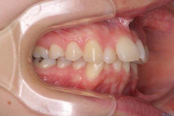 デコボコで飛び出した前歯　ワイヤー装置による抜歯矯正 治療前画像