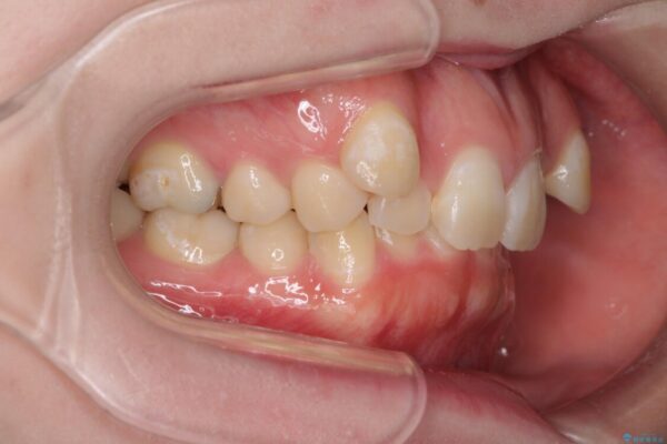 著しい八重歯を短期間で改善　ワイヤー装置による抜歯矯正 治療前画像