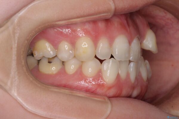 八重歯と前歯の欠損と骨格のズレ　目立たないワイヤー矯正 治療前画像