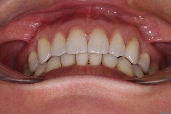抜歯矯正の後戻りをインビザライン・ライトで解消 治療後画像