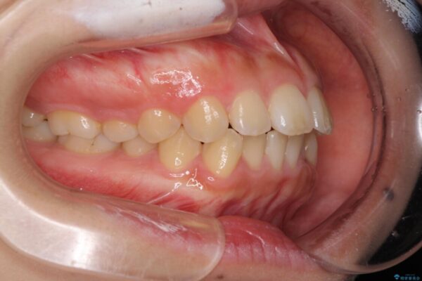 口元を引っ込めたい　目立たないワイヤー装置での抜歯矯正 治療前画像