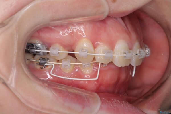 著しい八重歯を短期間で改善　ワイヤー装置による抜歯矯正 治療途中画像
