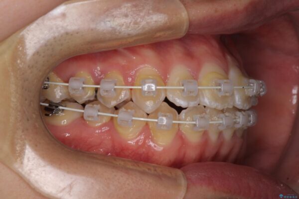 非抜歯ワイヤー装置による、短期間での矯正治療 治療途中画像
