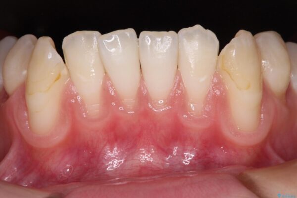 磨きすぎて傷が付くほどの歯根　歯肉移植術による根面被覆 治療前画像
