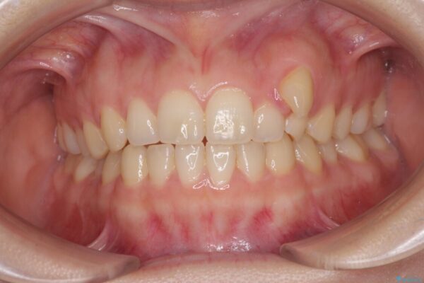 気になる残存乳歯と八重歯　ワイヤー矯正を併用したインビザライン治療 ビフォー