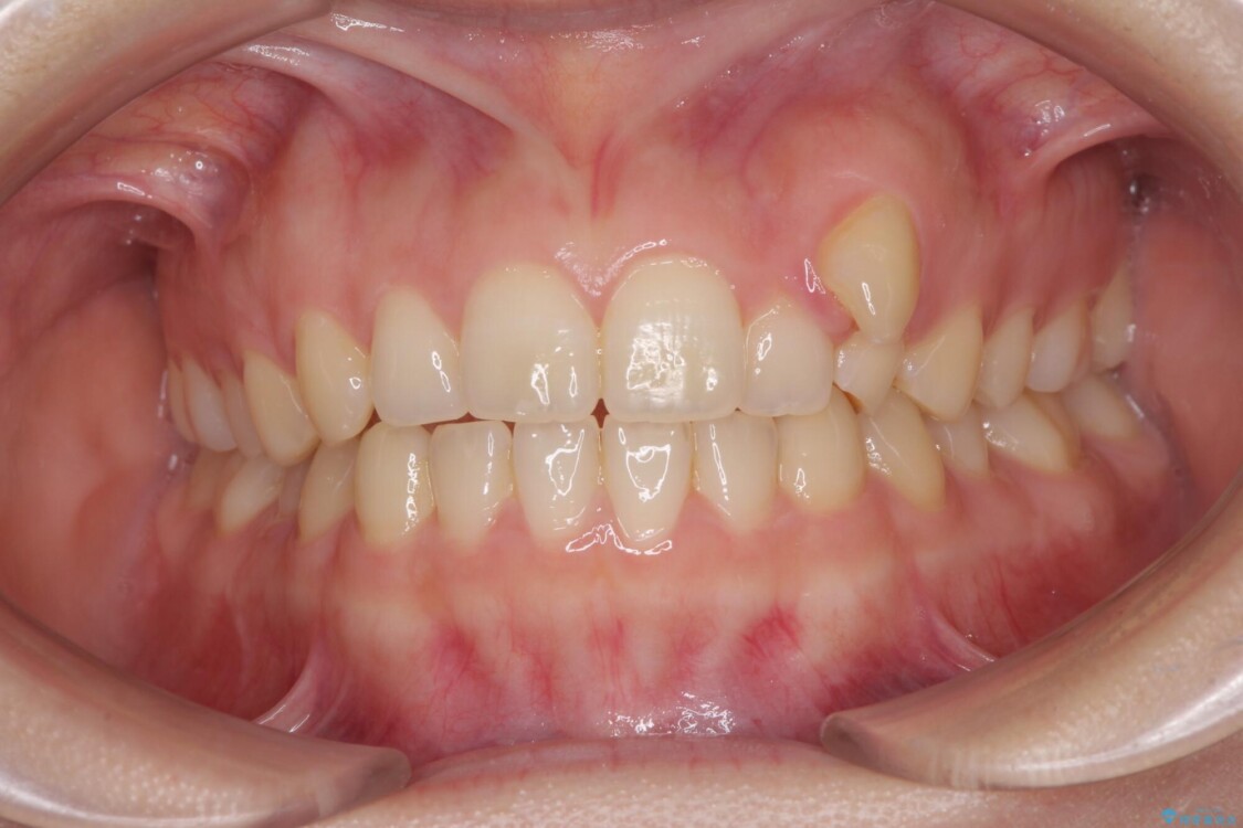 気になる残存乳歯と八重歯　ワイヤー矯正を併用したインビザライン治療 治療前