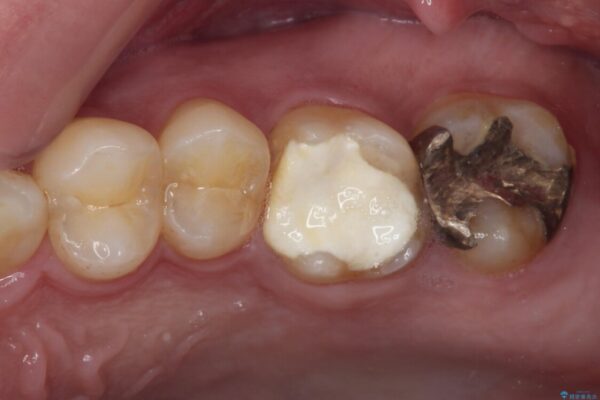 強い咬合力で生じた亀裂からむし歯に　奥歯のゴールドインレー治療 ビフォー