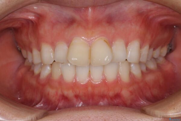 前歯の捻れを改善　インビザラインによる矯正治療 ビフォー
