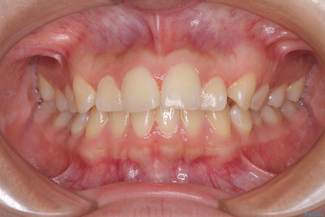 カリエール・ディスタライザーとインビザラインを用いた奥歯の咬み合わせ改善 治療前