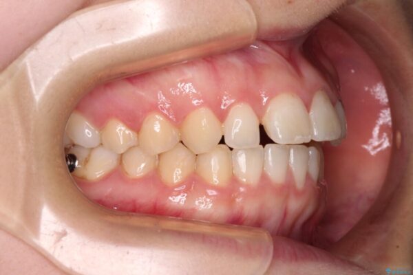気になる残存乳歯と八重歯　ワイヤー矯正を併用したインビザライン治療 治療途中画像