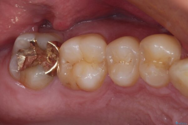 強い咬合力で生じた亀裂からむし歯に　奥歯のゴールドインレー治療 治療後画像