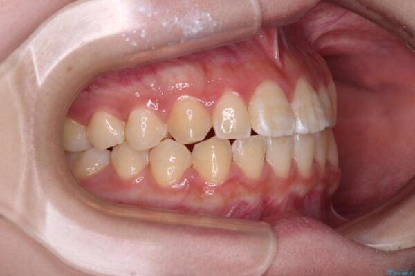 むし歯になりやすい奥歯　補助装置で一気に解決 治療後画像