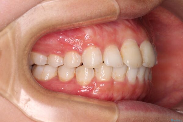 前歯の捻れを改善　インビザラインによる矯正治療 治療途中画像