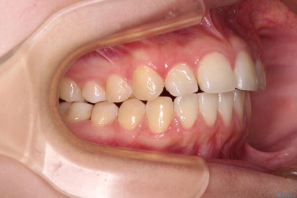 カリエール・ディスタライザーとインビザラインを用いた奥歯の咬み合わせ改善 治療途中画像
