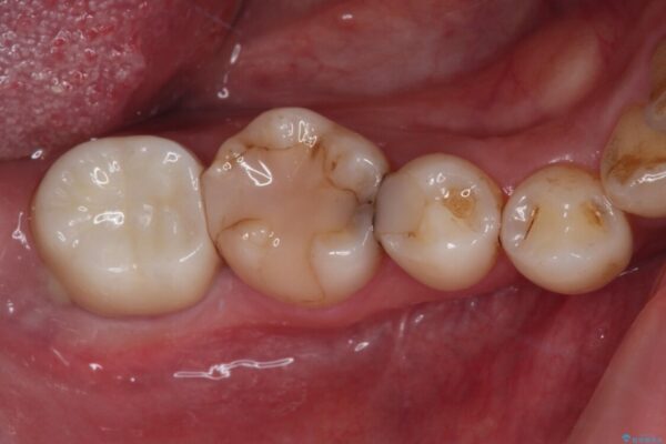セラミックは無理と言われた奥歯　フルジルコニアクラウンによる補綴治療 治療後画像