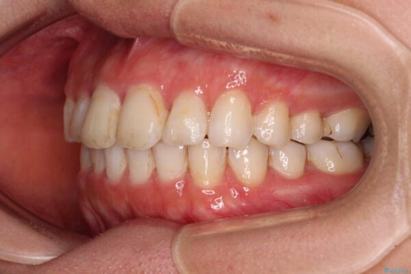 前歯の捻れを改善　インビザラインによる矯正治療 治療後画像