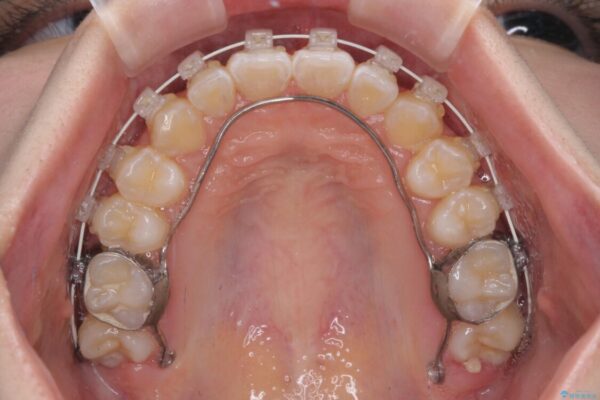 むし歯になりやすい奥歯　補助装置で一気に解決 治療途中画像