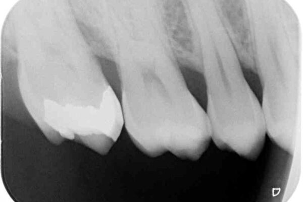 強い咬合力で生じた亀裂からむし歯に　奥歯のゴールドインレー治療 治療後画像