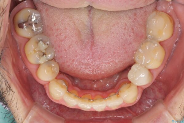 むし歯や銀歯が気になる　後戻りの再矯正治療とむし歯治療 治療前画像