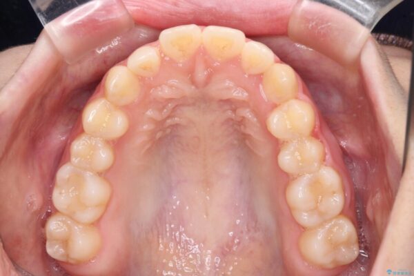 気になる残存乳歯と八重歯　ワイヤー矯正を併用したインビザライン治療 治療途中画像