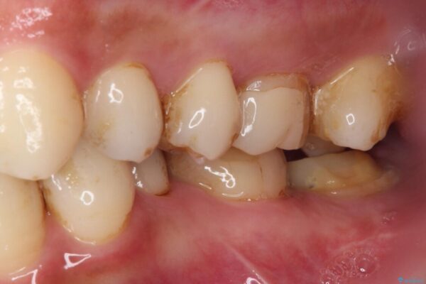 セラミックは無理と言われた奥歯　フルジルコニアクラウンによる補綴治療 治療前画像