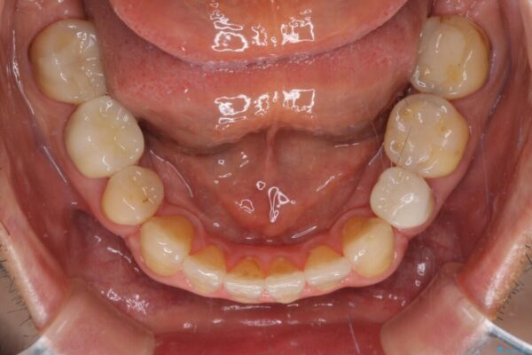 むし歯や銀歯が気になる　後戻りの再矯正治療とむし歯治療 治療途中画像