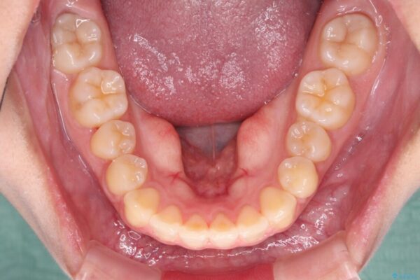 カリエール・ディスタライザーとインビザラインを用いた奥歯の咬み合わせ改善 治療途中画像