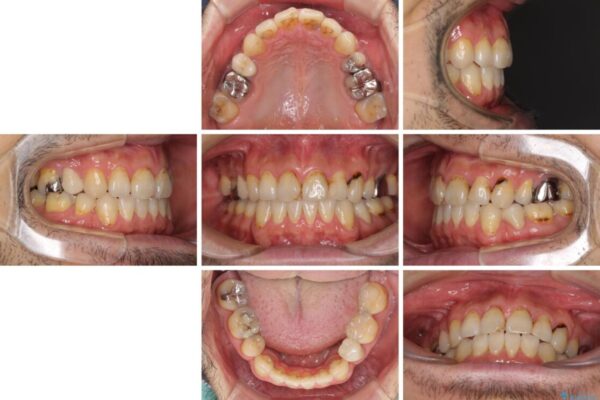 むし歯や銀歯が気になる　後戻りの再矯正治療とむし歯治療 治療前画像