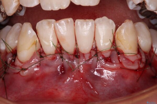 磨きすぎて傷が付くほどの歯根　歯肉移植術による根面被覆 治療途中画像