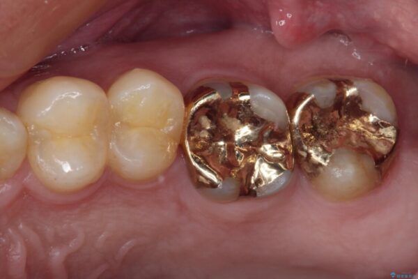 強い咬合力で生じた亀裂からむし歯に　奥歯のゴールドインレー治療 アフター
