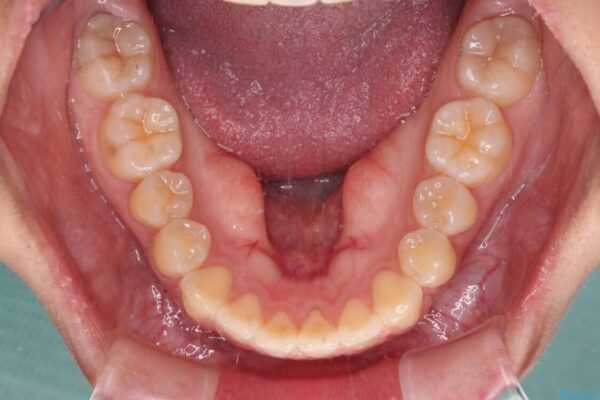 カリエール・ディスタライザーとインビザラインを用いた奥歯の咬み合わせ改善 治療後画像