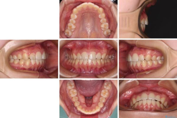 カリエール・ディスタライザーとインビザラインを用いた奥歯の咬み合わせ改善 治療後画像