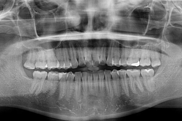 前歯の捻れを改善　インビザラインによる矯正治療 治療前画像