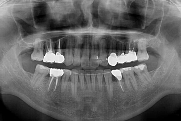 むし歯や銀歯が気になる　後戻りの再矯正治療とむし歯治療 治療後画像