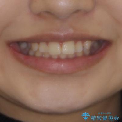 カリエール・ディスタライザーとインビザラインを用いた奥歯の咬み合わせ改善 治療前画像