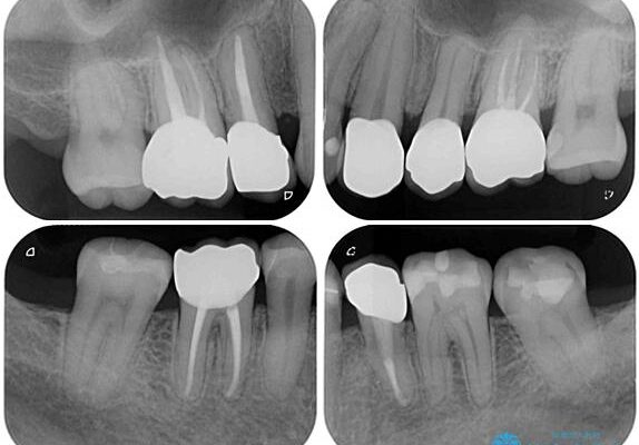 むし歯や銀歯が気になる　後戻りの再矯正治療とむし歯治療 アフター