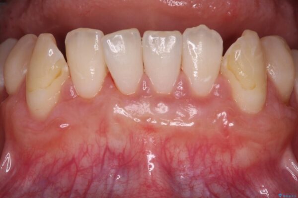 磨きすぎて傷が付くほどの歯根　歯肉移植術による根面被覆 治療後画像