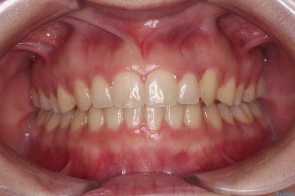 気になる残存乳歯と八重歯　ワイヤー矯正を併用したインビザライン治療 アフター